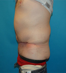 Patient # 81504 After Photo # 6