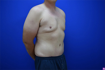 Patient # 42227 After Photo # 4