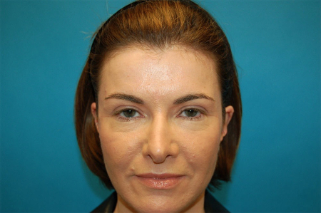 Patient # 49067 After Photo # 4