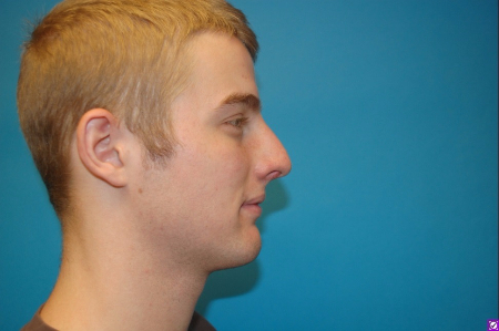 Patient # 60844 Before Photo # 3