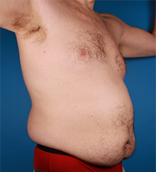 Patient # 81504 Before Photo # 3