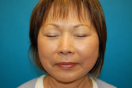 Patient # 67553 After Photo # 2