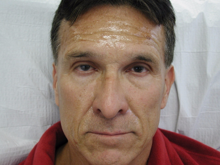 Patient # 70294 Before Photo # 1