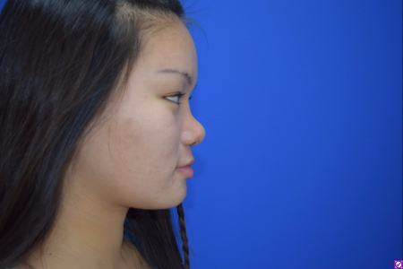 Patient # 69257 After Photo # 4