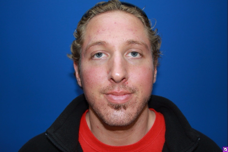 Patient # 12179 Before Photo # 1