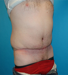 Patient # 81504 After Photo # 4