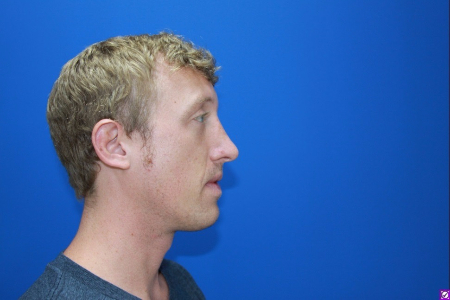 Patient # 92662 After Photo # 4