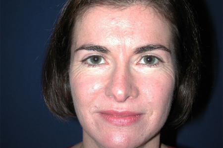 Patient # 49067 Before Photo # 3