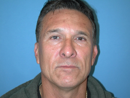 Patient # 70294 After Photo # 2