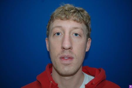 Patient # 92662 Before Photo # 1