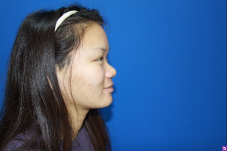 Patient # 69257 Before Photo # 3