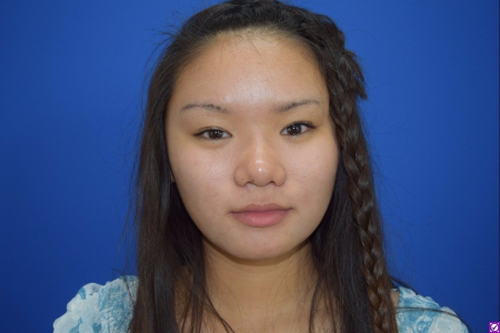 Patient # 69257 After Photo # 2