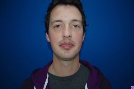 Patient # 28734 After Photo # 2