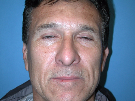 Patient # 70294 After Photo # 4