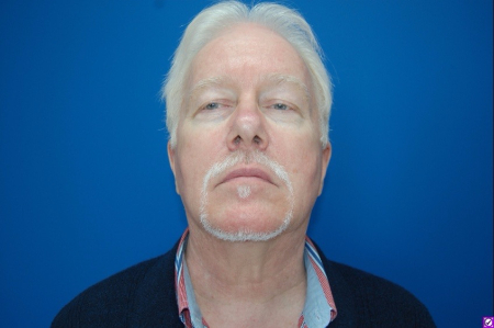 Patient # 61495 After Photo # 2