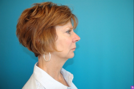 Patient # 82352 Before Photo # 3