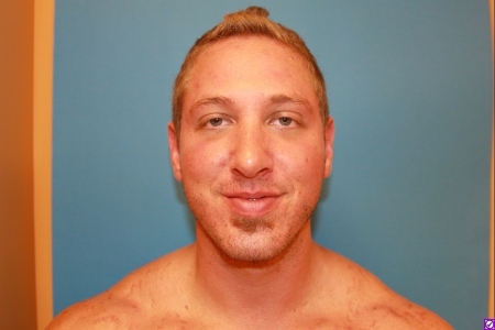 Patient # 12179 After Photo # 2