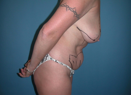 Patient # 17072 Before Photo # 5
