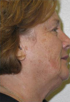 Patient # 88975 After Photo # 2