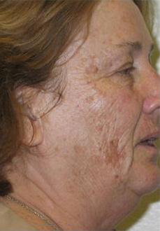 Patient # 88975 Before Photo # 1