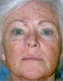 Patient # 45759 Before Photo # 1