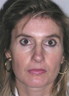 Patient # 50278 After Photo # 2