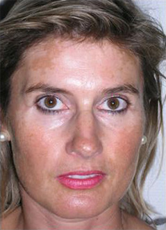 Patient # 50278 Before Photo # 1