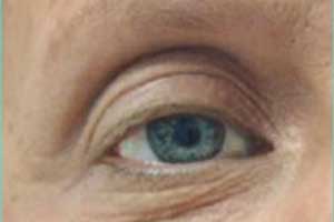 Patient # 93668 Before Photo # 1