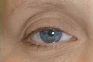 Patient # 93668 After Photo # 2