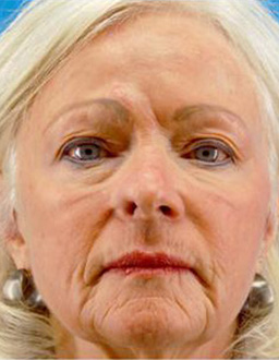 Patient # 45759 After Photo # 2