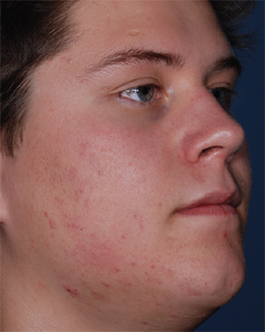 Patient # 17282 After Photo # 2