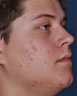 Patient # 17282 Before Photo # 1