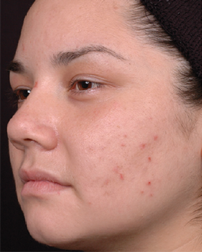 Patient # 68799 Before Photo # 1