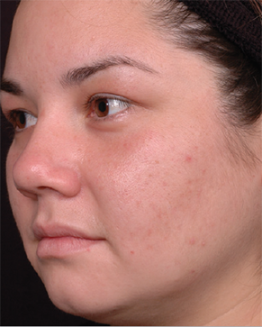 Patient # 68799 After Photo # 2