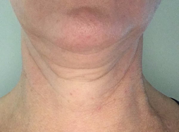 Patient # 81687 Before Photo # 3