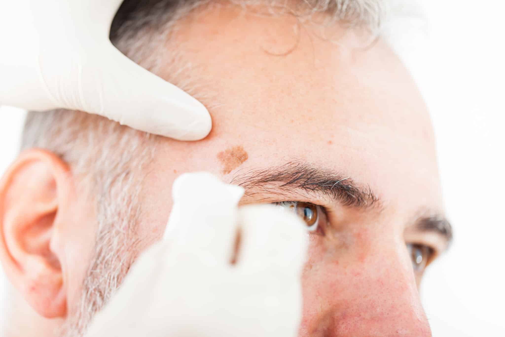 Skin Cancer Removal | Skin Cancer Reconstruction Grand Rapids MI Skin Cancer Removal | Skin Cancer Reconstruction Grand Rapids MI