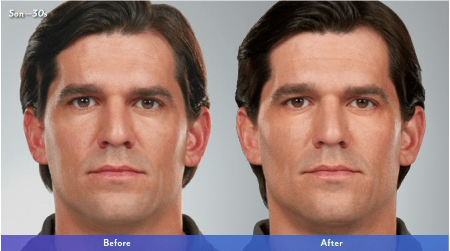 Juvederm For Men Grand Rapids MI