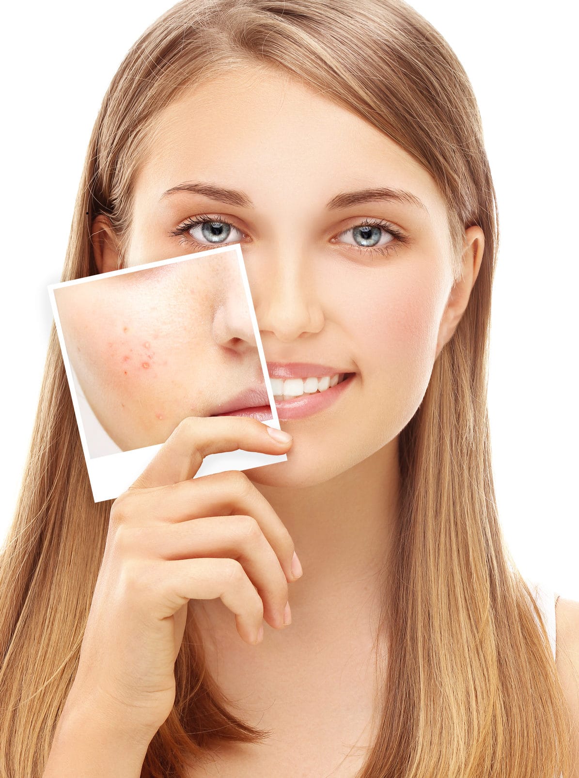 close up headshot of woman holding photo of previous acne scars against her face with solid white background behind her