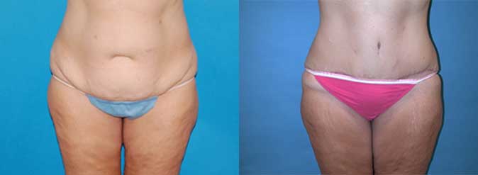 before and after photos of woman's stomach showing vast improvement in skin tightness after tummy tuck