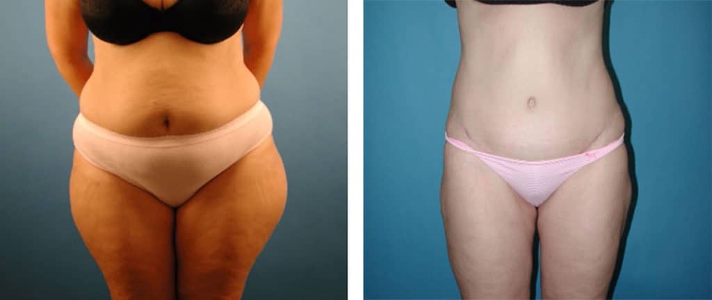 Liposuction Grand Rapids MI | Liposuction Before & After