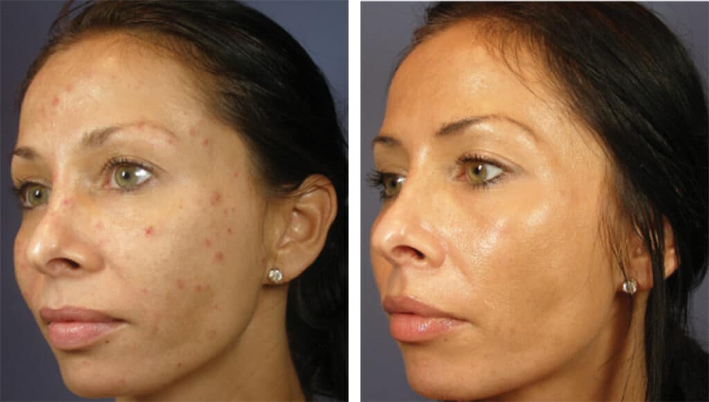 Chemical Peel | Grand Rapids, MI