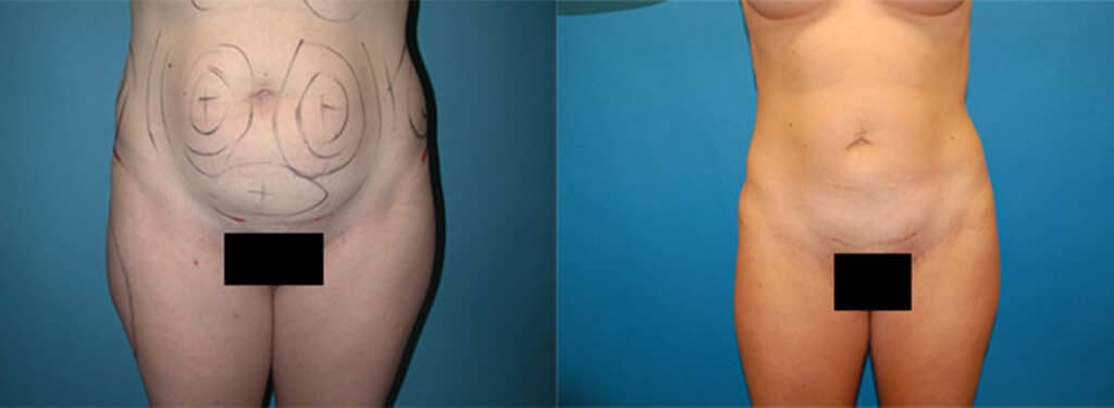 Liposuction Grand Rapids, MI