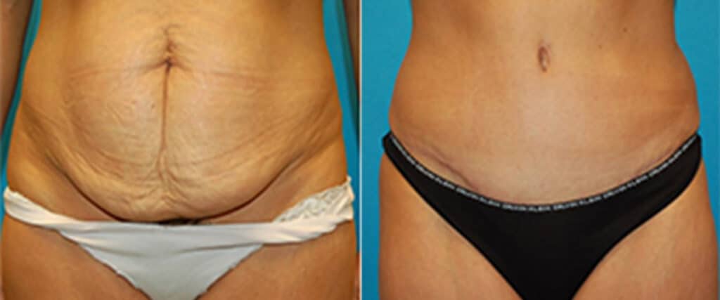 Tummy Tuck Grand Rapids, MI