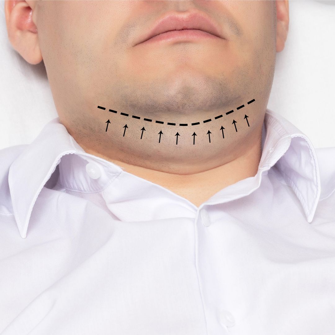 Upgrade Your Chin - Plastic Surgery in Grand Rapids, MI