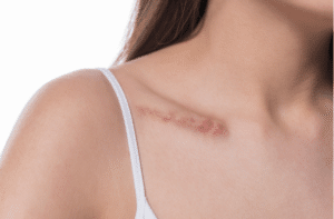 woman showing surgery scar.