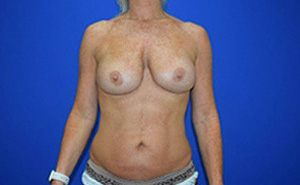 Patient # 16895 After Photo # 2