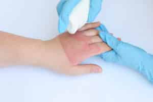 Doctor's hands holding a female patient burn hands