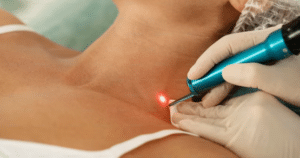 Laser Treatment Surgeon Grand Rapids MI