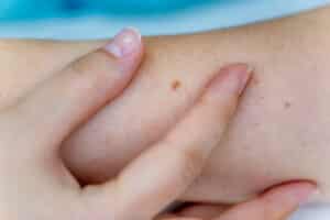Skin cancer removal

