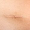 scar revision